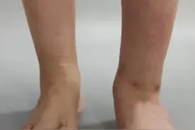 先天性双足畸形，病根竟在腰上？图片