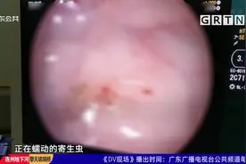 中山：少女肠道内布满寄生虫 疑因长期吃鱼生所致视频封面