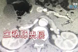 开车太颠导致脑梗？37岁货车司机因血管夹层住院 医生：年轻人也应关注脑卒中图片