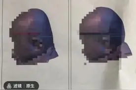 2.8万的“头盔”让婴儿头型变美？医生：或妨碍发育图片
