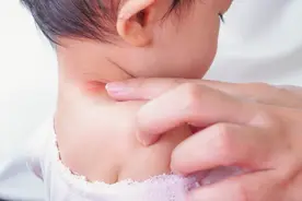 新生儿疹子不都是捂出来的，颈部、腹股沟出现小白点应警惕脓疱疮图片