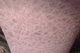 鱼鳞病的症状？老年鱼鳞病患者应注意什么？该如何预防鱼鳞病？图片