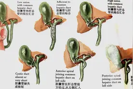 画说胆道变异以及术中识别与处理图片