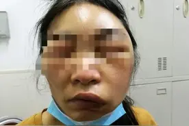 一觉醒来，女子脸部肿胀变形差点窒息！最近要特别注意图片