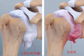 肩周炎的治疗手段图片