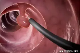 肠镜能发现早期肠癌，医生建议：有这3种情况的人，最好定期检查图片