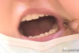 太脆了！新装烤瓷牙半年碎两回图片