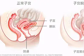 大妈跳广场舞突然掉下“一块肉”，医生竟说是子宫图片
