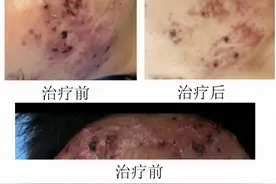 如何拯救我那满目疮痍的脸---一位重度痘痘患者治疗经历分享图片