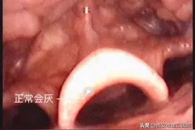 致命的咽痛 | 急性会厌炎不可大意图片