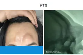 兰州市第二人民医院多学科协作切除病变重建颜面结构、还患者美丽容颜图片