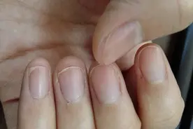 指甲上长满竖纹，说明体质差？是肝病的信号？有疑问的人早点看看图片