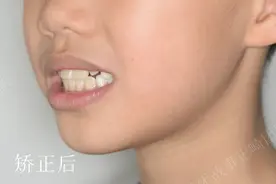 解除前牙反颌，孩子正常发育图片