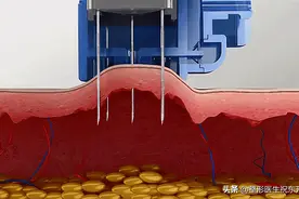 医生同你讲讲：关于“打水光针”的那些事图片