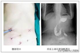 砥砺前行，勇于攀登——让胃癌腹腔镜手术患者“微创+”图片
