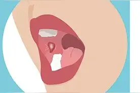 口腔溃疡老不好，从用药到护理，记住这三步图片