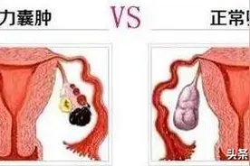 什么是巧克力囊肿？巧克力囊肿可以做试管婴儿吗？图片