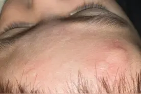 现在蚊子特别多，手脚被咬了，感觉到处都痒图片