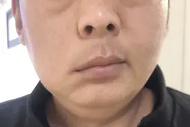 眼皮老跳动，可能是面肌痉挛缠身图片