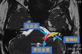 面肌痉挛科普问答图片