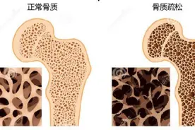 南昌大学二附院系列科普：一摔就骨折，不是娇气都是骨质疏松惹的祸图片