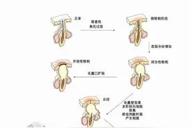 长痘是因为脸没有洗干净导致毛孔堵塞引起的吗？图片