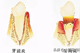火速围观，是什么让可怕的牙周病找上你？图片