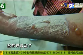 三年前网购水壶 如今手柄断裂 热水烫伤手臂能否成功索赔？图片