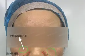 从整形医生的角度来聊一聊形成法令纹的原因以及改善方案图片