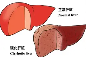 协和科普：快来抄笔记！肝硬化患者干饭要点大放送图片
