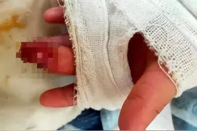 细思极恐！4岁女童玩这个睡着，差点截肢……图片