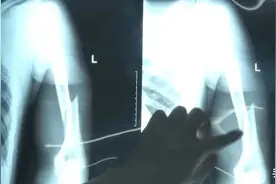 冲上热搜！大学生掰手腕，手臂断了......图片