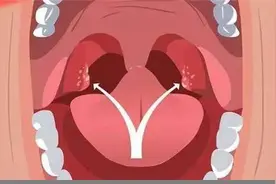 每天多刷两次牙，还是有口臭？可能嘴里长了“小石头”图片
