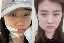 拔牙后脸肿的见不了人？教你几招，轻松缓解疼痛图片