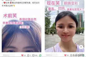 从果汁脸到凹坑怪人，花5万拉皮的我就这样毁容了…图片