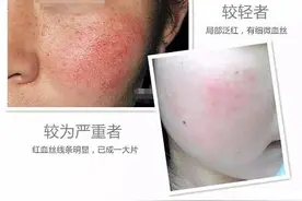 脸红也许不只是“害羞”，可能是皮脂膜受损！图片