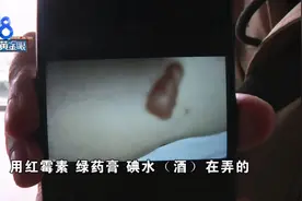 在养生馆打通“任脉”，女子被严重烫伤！店家：调理会有烫伤风险，又不是武侠小说图片