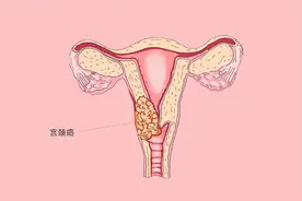 38岁女子查出宫颈癌，医生提醒：感染HPV时有症状，需多观察图片