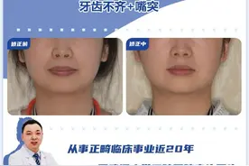 牙齿是骨性问题，不做手术的话还能矫正吗？|武汉牙齿矫正图片