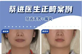 牙齿是骨性问题，不做手术的话还能矫正吗？|武汉牙齿矫正图片