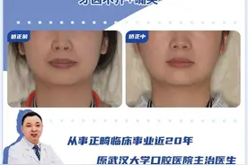 牙齿是骨性问题，不做手术的话还能矫正吗？|武汉牙齿矫正图片