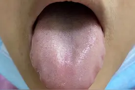 齿痕舌是内湿顽固的标志，教你4个方法，长期坚持消齿印图片