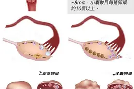 多囊卵巢综合征的致病原因是什么，有什么危害？图片