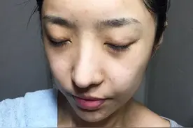 毛孔油脂分泌过多，造成堵塞毛囊形成痘痘怎么办图片