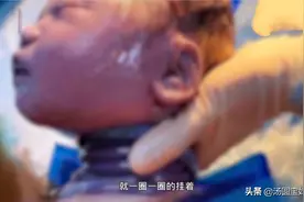 脐带绕颈6周"围脖宝宝"顺产出生，医生：我工作23年第一次见到图片