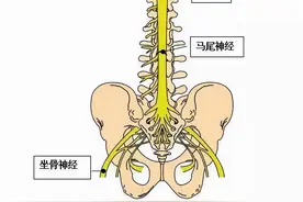 腰椎间盘突出压迫哪个神经更严重？坐骨神经？马尾神经？图片