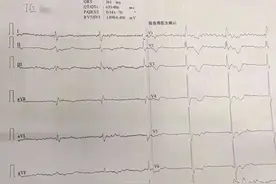 心房颤动合并三度房室传导阻滞图片