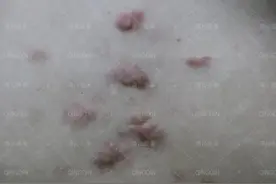 瘢痕疙瘩不痛不痒，是不是不用治疗了？图片