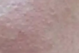脸痒烧灼感三天图片