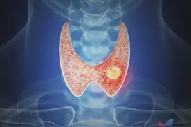 体检查出甲状腺结节或会变成癌？现在知道还不晚…图片